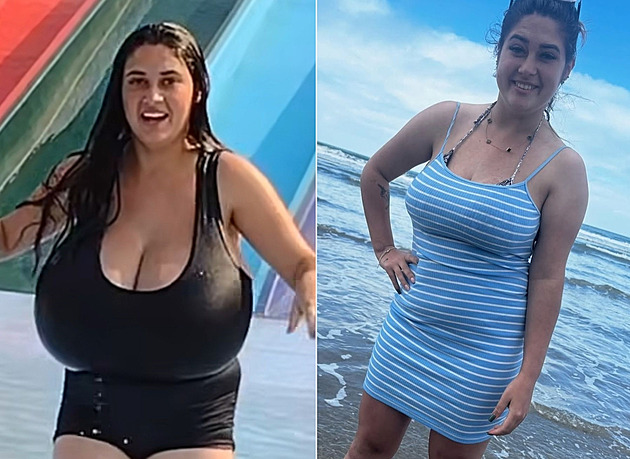 Kvůli obřím ňadrům jezdila na vozíku, po zmenšení prsou je žena šťastná